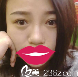 内江达芬奇隆鼻术前鼻头大,鼻子塌 内江达芬奇隆鼻术前鼻头大,鼻子塌