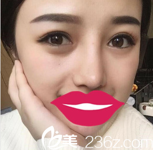膨体隆鼻+鼻头缩小术后2个月照片 膨体隆鼻+鼻头缩小术后2个月照片