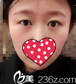 做双眼皮术前照 做双眼皮术前照