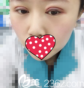 双眼皮术后3天照 双眼皮术后3天照