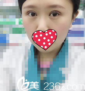 双眼皮一周拆线 双眼皮一周拆线