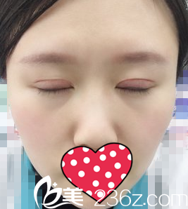 纳米无痕双眼皮半个月效果 纳米无痕双眼皮半个月效果