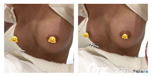 安徽合肥韩美整形美容医院做假体隆胸第3天照