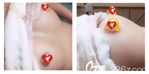 在安徽韩美整形美容医院做假体丰胸第7天拆线的图片