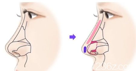 北海维纳斯综合隆鼻术方法