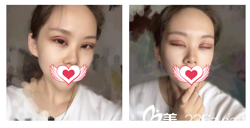 在安庆维多利亚整形做眼综合术后第1天恢复情况 在安庆维多利亚整形做眼综合术后第1天恢复情况