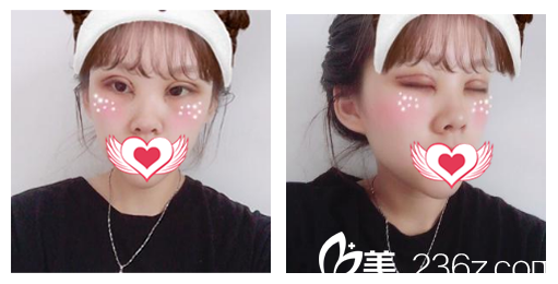 安庆维多利亚整形端木义勇割双眼皮+开内眼角+眼部脂肪去除眼综合术后第3天恢复效果 安庆维多利亚整形端木义勇割双眼皮+开内眼角+眼部脂肪去除眼综合术后第3天恢复效果