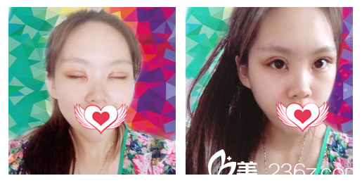 找安庆维多利端木义勇做眼综合整形术后第7天拆线后照片 找安庆维多利端木义勇做眼综合整形术后第7天拆线后照片