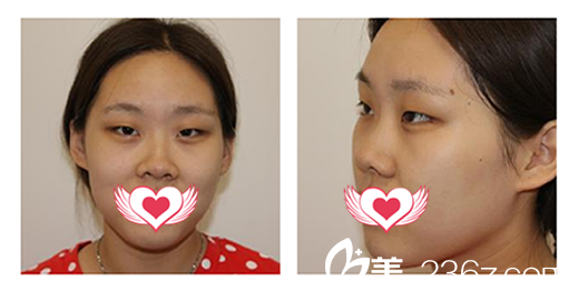 没有去安庆维多利亚整形做全切双眼皮+开内眼角+上眼睑脂肪取出眼综合整形前的样子 没有去安庆维多利亚整形做全切双眼皮+开内眼角+上眼睑脂肪取出眼综合整形前的样子