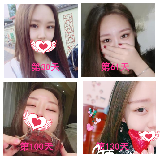 在安庆维多利亚做眼综合整形4个月了 小花们看看我的眼睛漂亮吗