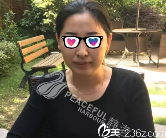 40岁的玉玲做埋线提升前照片 40岁的玉玲做埋线提升前照片