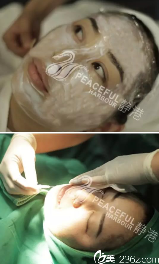 宁波静港面部线雕手术过程图 宁波静港面部线雕手术过程图