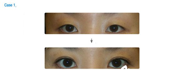 韩国可恩爱整形外科医院院长李圣吉双眼皮手术真人案例 韩国可恩爱整形外科医院院长李圣吉双眼皮手术真人案例