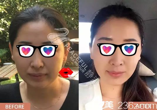 宁波静港程卫民面部线雕案例对比图 宁波静港程卫民面部线雕案例对比图