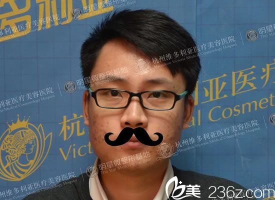 在杭州维多利亚祛痘前照片 在杭州维多利亚祛痘前照片