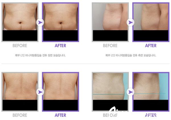 Kim Ginam吸脂手术案例 Kim Ginam吸脂手术案例