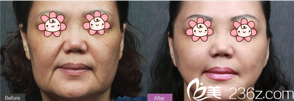 汪国应埋线提升案例 汪国应埋线提升案例