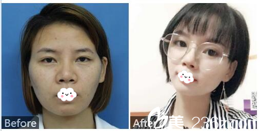 深圳和协门诊部整形美容科自体脂肪填充案例