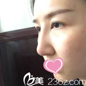 九江瑞丽医疗美容医院完成双眼皮真人案例 九江瑞丽医疗美容医院完成双眼皮真人案例