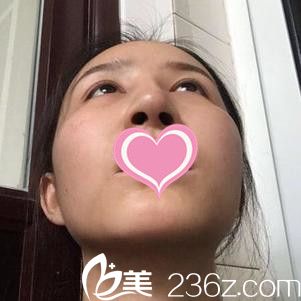 九江瑞丽医疗美容医院万成隆鼻手术案例 九江瑞丽医疗美容医院万成隆鼻手术案例