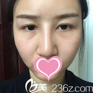 万成隆鼻手术案例 万成隆鼻手术案例