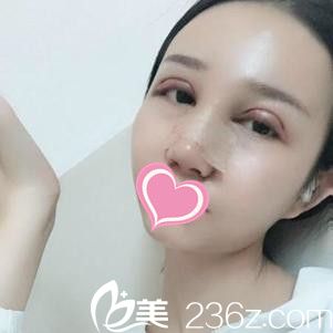 九江瑞丽双眼皮+隆鼻手术真人案例 九江瑞丽双眼皮+隆鼻手术真人案例
