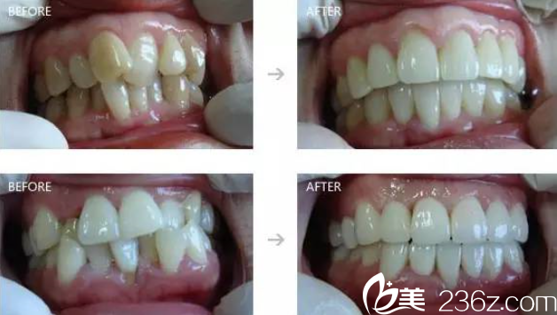 王家顺牙齿矫正