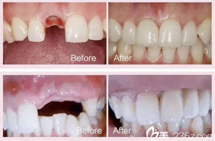 贵州利美康牙齿种植案例 贵州利美康牙齿种植案例