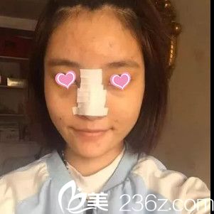 赣州俪人医疗美容医院隆鼻手术真人案例