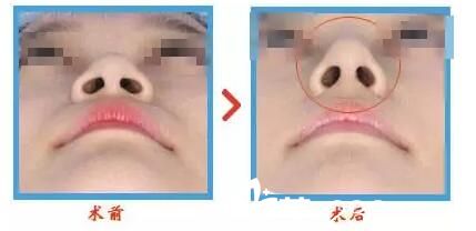 现在流行美女 说说我的2位朋友在荆州美傲注射隆鼻和祛眼袋的整形经历