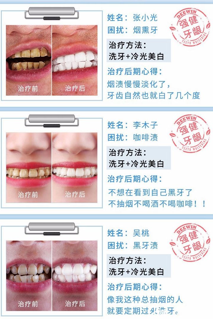 无锡同舟牙齿美白案例