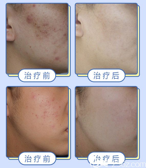 <!--<i data=20240703-sp></i>-->华医生祛痘案例