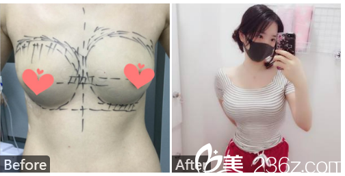 广州健丽今生医疗美容医院麦凯欣自体脂肪隆胸案例