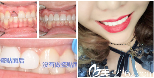 广州雅度口腔医院种植牙和瓷贴面案例