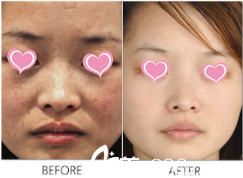 北京薇琳医疗美容医院王瑞鹃皮秒激光祛斑案例