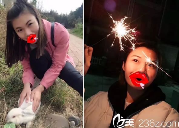 做鼻综合隆鼻前的塌鼻子 做鼻综合隆鼻前的塌鼻子