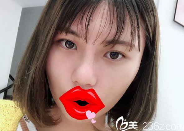 在嘉兴曙光做完隆鼻手术10天效果 在嘉兴曙光做完隆鼻手术10天效果