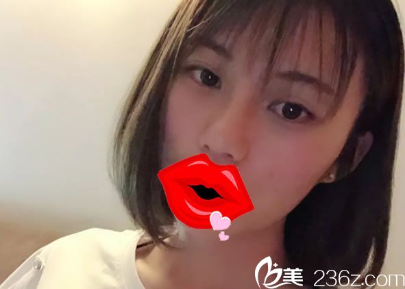 嘉兴曙光王旭明院长为员工成功实施自体肋软骨综合隆鼻手术小翘鼻得来