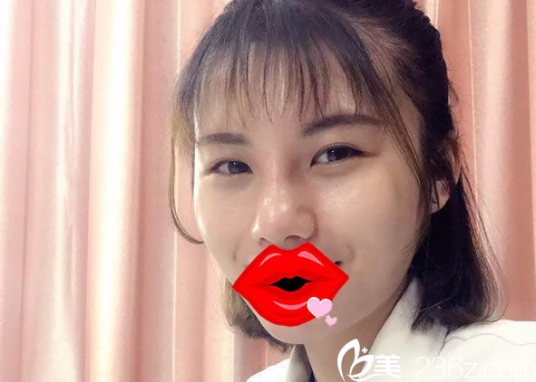 做完自体软骨隆鼻手术后工作照 做完自体软骨隆鼻手术后工作照