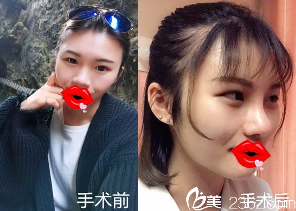 嘉兴曙光自体软骨隆鼻案例对比图 嘉兴曙光自体软骨隆鼻案例对比图