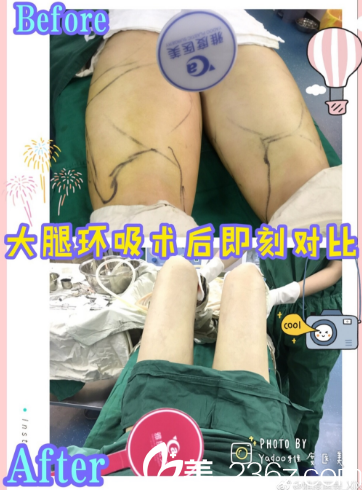 广州雅度医美大腿吸脂案例