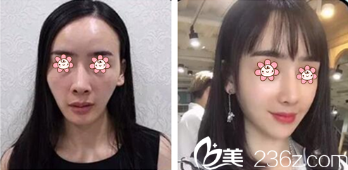 张连洪自体脂肪全脸填充案例