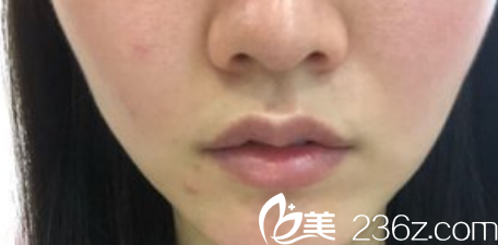 在蚌埠人民医院做了唇部注射物出去+M唇手术后 “香肠唇”变成了性感嘟嘟唇