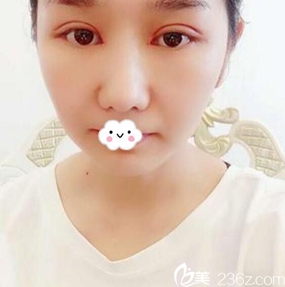 淮北微悦（伊尔美）医疗美容门诊部双眼皮案例