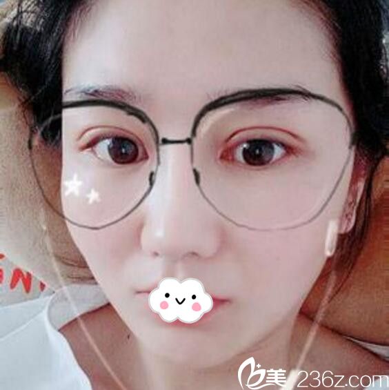 淮北微悦（伊尔美）医疗美容门诊部双眼皮+开眼角