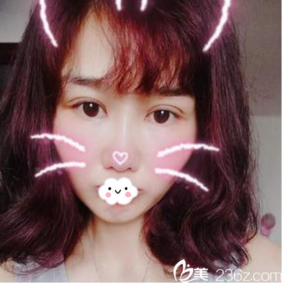 淮北微悦（伊尔美）医疗美容门诊部全切双眼皮+开眼角案例