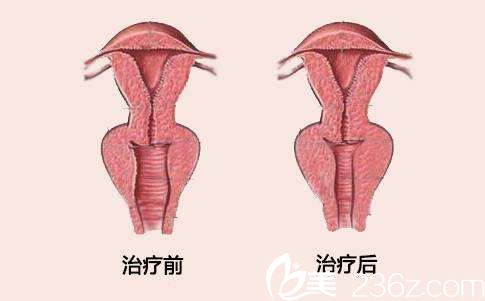 张锦峰做阴道紧缩术前后对比