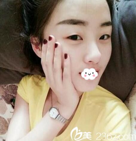 淮北微悦(伊尔美)医疗美容门诊部双眼皮术前 淮北微悦(伊尔美)医疗美容门诊部双眼皮术前