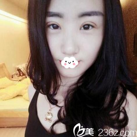淮北微悦(伊尔美)医疗美容门诊部胡斌双眼皮案例 淮北微悦(伊尔美)医疗美容门诊部胡斌双眼皮案例