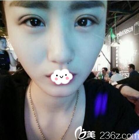 淮北微悦(伊尔美)医疗美容门诊部全切双眼皮案例 淮北微悦(伊尔美)医疗美容门诊部全切双眼皮案例